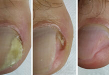 Onycholiza – odstający problem