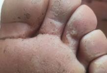 Keratoliza dziobata. Cz. 1. Etiopatogeneza i profilaktyka