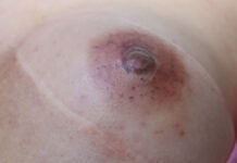 Mikropigmentacja rekonstrukcyjna brodawki piersiowej