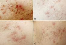 Skuteczność roztworu Jessnera w połączeniu z retinolem w redukcji zmian trądzikowych – badanie pilotażowe