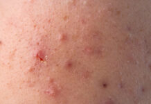 Czynniki wpływające na przebieg trądziku różowatego