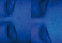 Pielęgnacja skóry w atopowym zapaleniu skóry – studium przypadku