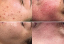 Fotodynamika w praktyce kosmetologów