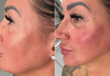 Stymulatory tkankowe a wypełniacze