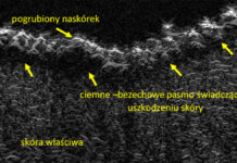 USG skóry – niskie a wysokie częstotliwości