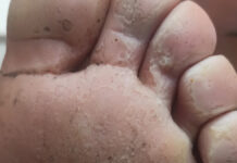 Keratoliza dziobata. Cz. 2. Terapia łączona w gabinecie podologicznym – opis przypadku