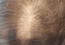 Zmiany skórne w zespole policystycznych jajników