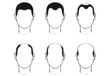 Łysienie androgenowe typu męskiego – charakterystyka i przegląd terapii dostępnych w gabinetach kosmetologicznych i medycyny estetycznej