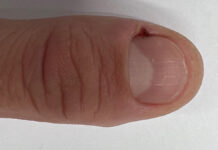 Zanokcica – choroba bakteryjna wału paznokciowego