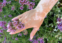 Bielactwo nabyte u kobiet. Piękno czy powód do piętnowania?