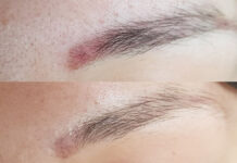 Remover vs. laser – okiem linergistki