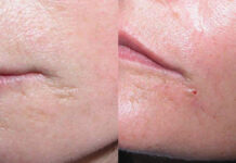 Mezoterapia igłowa i stymulatory tkankowe w praktyce – projektowanie skutecznych terapii