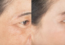 Rola czepca ścięgnistego w liftingach twarzy i napięciowych bólach głowy