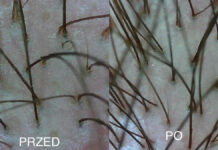 Colostrum bovinum w pielęgnacji skóry głowy i włosów