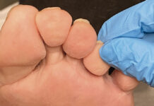 Zmiany grzybicze stóp i paznokci