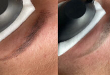 Laserowe usuwanie makijażu permanentnego i tatuażu