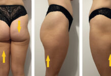 Zastosowanie radiofrekwencji i masażu podciśnieniowo-mechanicznego w redukcji cellulitu. Opis przypadku