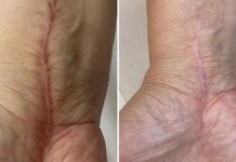 Mikropunktura – skuteczna technika przebudowy skóry o spektakularnych efektach