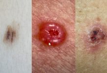 Promieniowanie słoneczne jako czynnik nowotworzenia w obrębie skóry