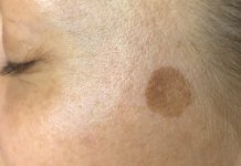 Terapie zaburzeń barwnikowych