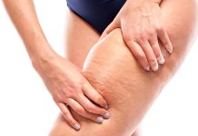 Ocena poziomu wiedzy społeczeństwa na temat cellulitu i metod jego redukcji