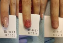 Paznokcie w gabinecie podologicznym – urazy mechaniczne i uszkodzenia