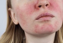 Atopowe zapalenie skóry w gabinecie kosmetologicznym