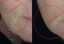 Skuteczność mezoterapii z wykorzystaniem mechanizmu fibroplazji tkankowej w redukcji oznak starzenia się skóry