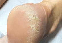 Zmiękczenie przez nawilżenie. Usuwanie zrogowaceń połączone z pielęgnacją stóp