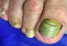 Zakażenie bakterią Pseudomonas aeruginosa a stylizacje hybrydowe