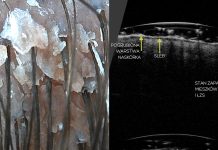 Obrazowanie ultrasonograficzne w diagnostyce trychologicznej