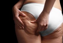 Współczesne metody diagnostyki cellulitu oraz jego redukcji