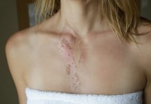 Popromienne zapalenie skóry jako działanie niepożądane radioterapii