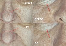 Wpływ biomikronakłuwania oraz składników aktywnych na parametry skóry u kobiet z widocznymi oznakami starzenia. Badanie pilotażowe