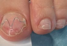 Podologia estetyczna. Czy podolog może zajmować się stylizacją paznokci?