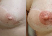 Pigmentacja z różową wstążką