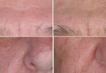 Zastosowanie azeloglicyny w pielęgnacji cery naczyniowej i trądziku różowatego