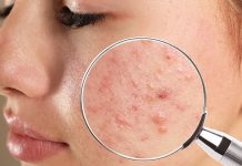 Stres a choroby skóry. Omówienie na przykładzie trądziku pospolitego