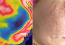 Blizna w gabinecie kosmetologicznym. Termografia i wybrane terapie