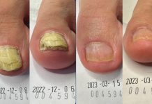 Terapia paznokcia zmienionego chorobowo – studium przypadku