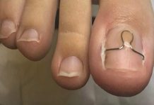 Wrastające paznokcie (Unguis incarnatus)