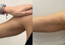 Clinical response to infra-red device treatmentin combination with PEGylated dermal fillerin a woman with skin laxity on the arms. Case report