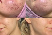 Zastosowanie substancji złuszczających i mezoterapii mikroigłowej w redukcji objawów trądziku pospolitego. Opis przypadku