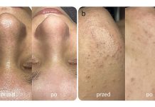 Wodór cząsteczkowy (H2) – właściwości terapeutyczne dla skóry oraz metody aplikacji