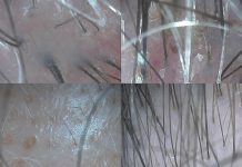 Mikrobiom skóry głowy. Dążenie do osiągnięcia równowagi mikrobiologicznej