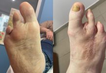 Skalpel w rękach podologa. Cz. I. Praca ze stopą cukrzycową