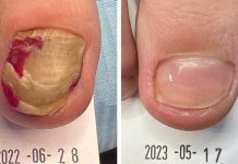 Onychogryfoza – „szponowatość” paznokci. Studium przypadku