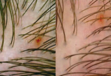 Zastosowanie kapilaroskopii w obrazowaniu owłosionej skóry głowy