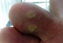 Brodawki wirusowe „kurzajki” w obrębie stóp