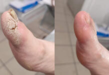 Skalpel w rękach podologa. Cz. II. Precyzyjne zabiegi podologiczne wymagające użycia mikroostrzy